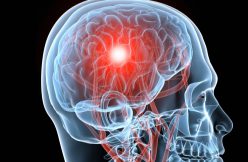 brain-injury